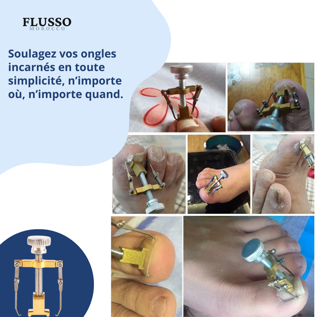 Nail Fixer™ | Correcteur d’Ongles Incarnés